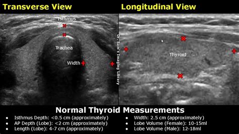 isthmus measures 15 mm in thickness|normal thyroid measurements on ultrasound.